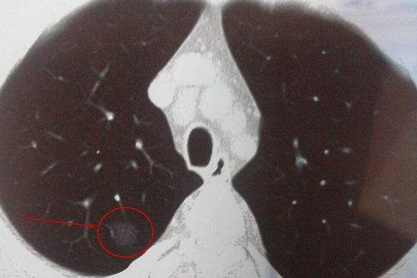 蛋糕|哪些人容易出现肺部结节?肺部结节小于这个值,通常是良性!
