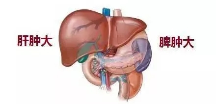 肝硬化|肝硬化出现脾大是早期还是晚期?