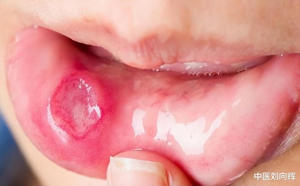 丝瓜络|药店里不起眼的连花清瘟胶囊,不仅能清热解毒,还能治疗这5种病