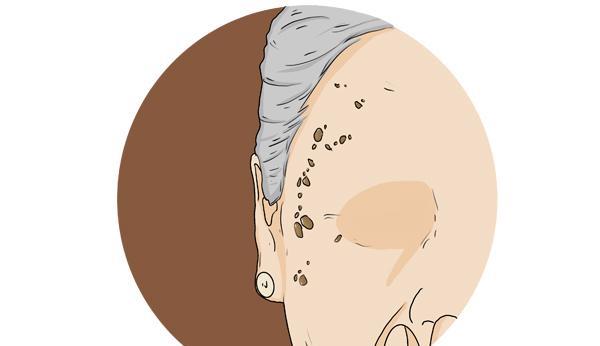 大脑|多少岁长老年斑是正常的？生姜擦拭能管用吗？不妨看看