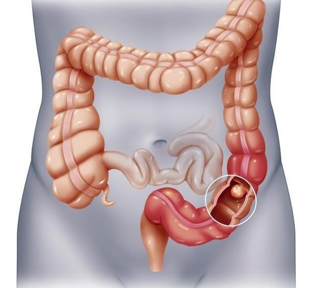 肉桂|什么是肠息肉？肠子出现“息肉”时，会有哪些临床表现？