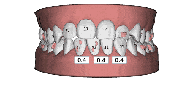 山药|为什么有些人矫正完会反弹?矫正结束要注意哪些问题,牙医告诉你