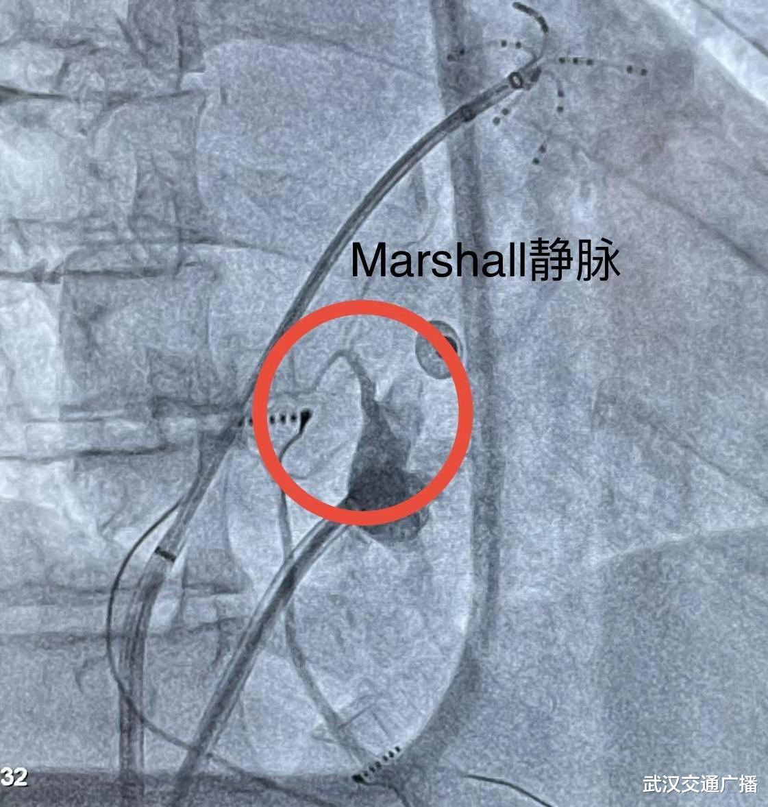 医院|酒精还能这样用?让心肌“饮酒”能解顽固心疾——Marshall静脉消融解除顽固房颤