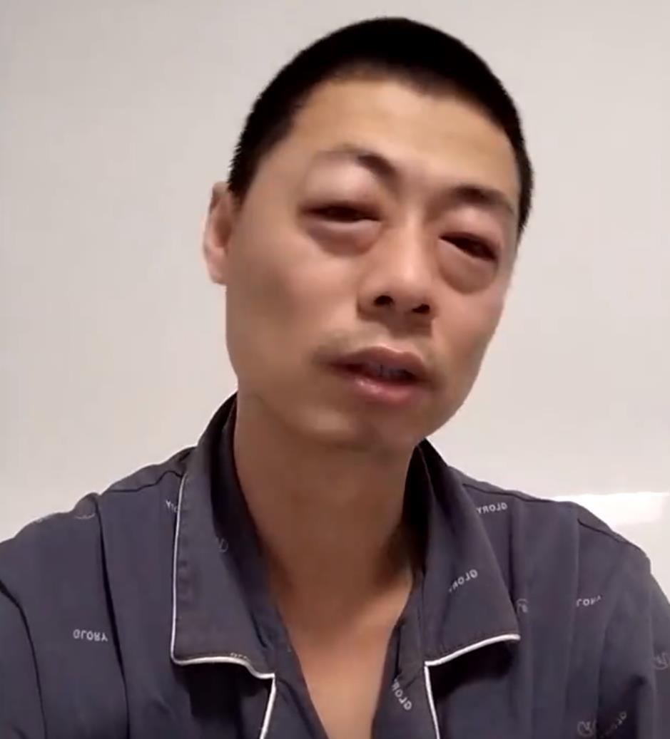 男子自称感染“哭株”流泪眼肿,网友纷纷晒出“睡株”、“炫饭株”、“学习株”