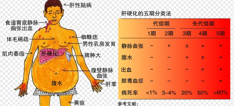 肝硬化|肝硬化常见的并发症有哪些？