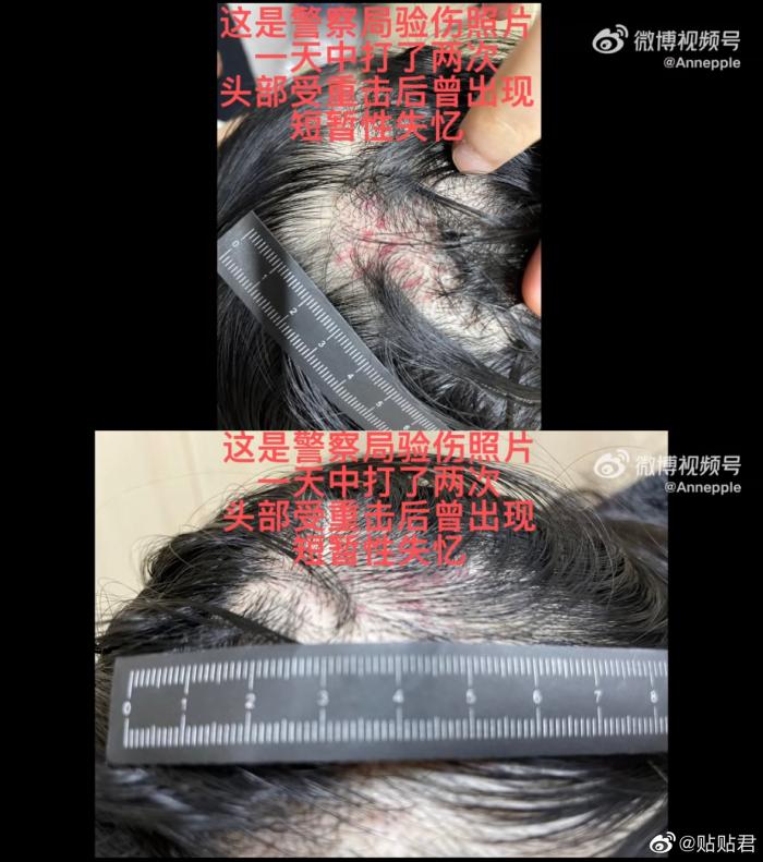 又一演员被曝家暴,晒验伤照片证明自己所言非虚
