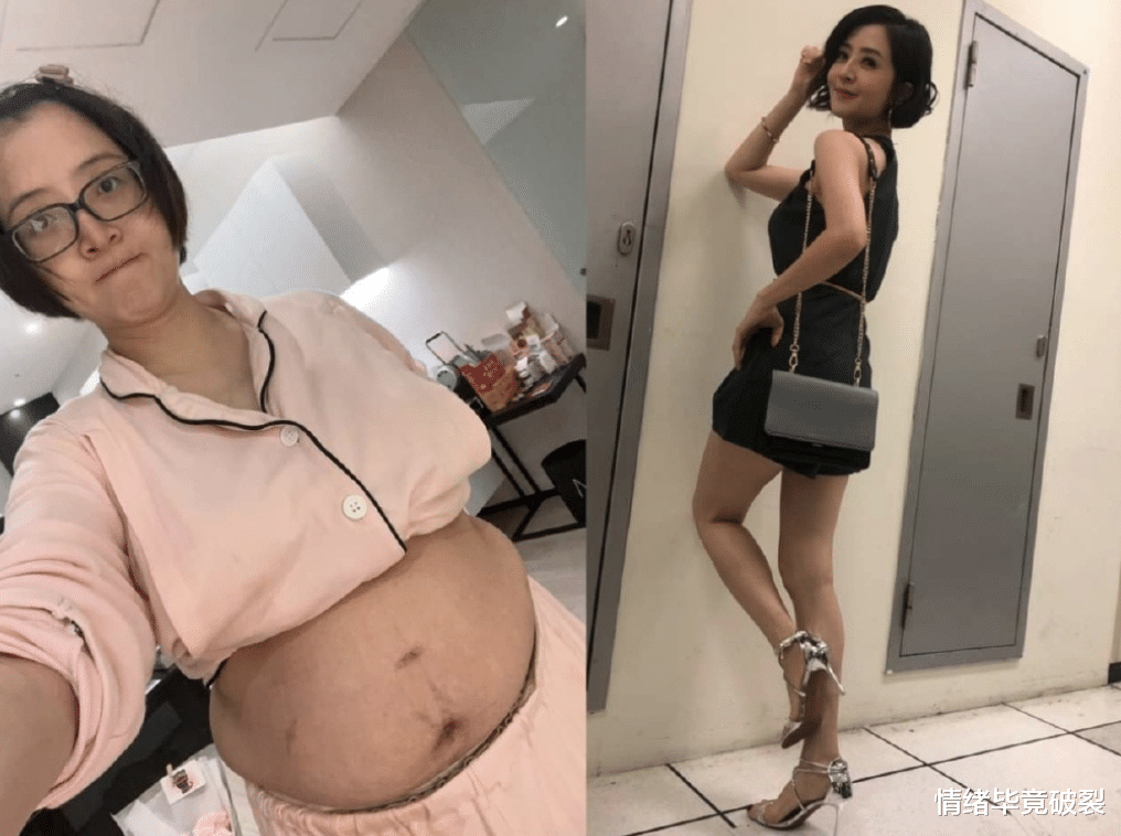 妊娠纹|台湾女星掀起上衣晒孕肚!妊娠纹布满大肚皮,身形臃肿一脸疲惫