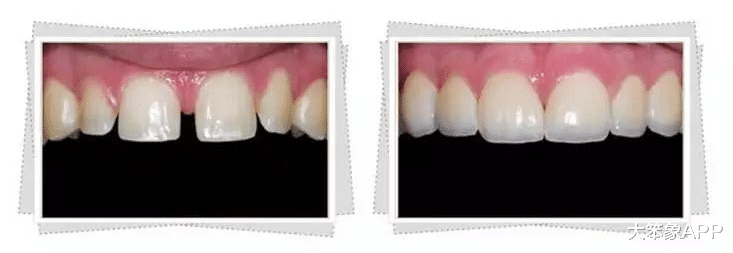 牙齿|牙缝过大的处理方法和注意事项
