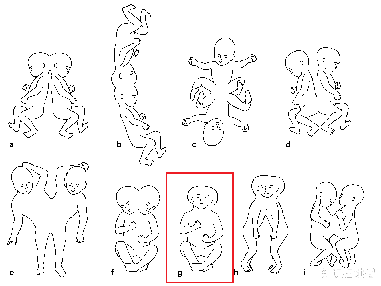 后脑勺长着另一张脸的“双面人”,科学家:虽罕见,但存在
