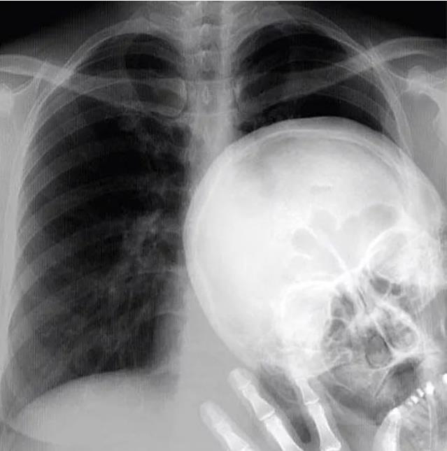 肺癌|盘点30张奇奇怪怪的X光片，看完整个人都不好了！