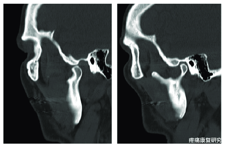 运动|通过下颌活动来缓解颞下颌关节紊乱