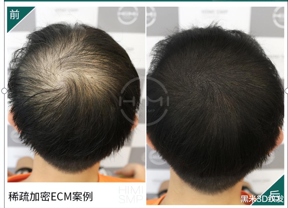 痰濕體質|防止脫發，那些坑人小妙招，禿得更徹底