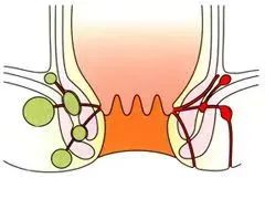 肛瘘|关于肛瘘手术,这七个关键问题一定要知道!