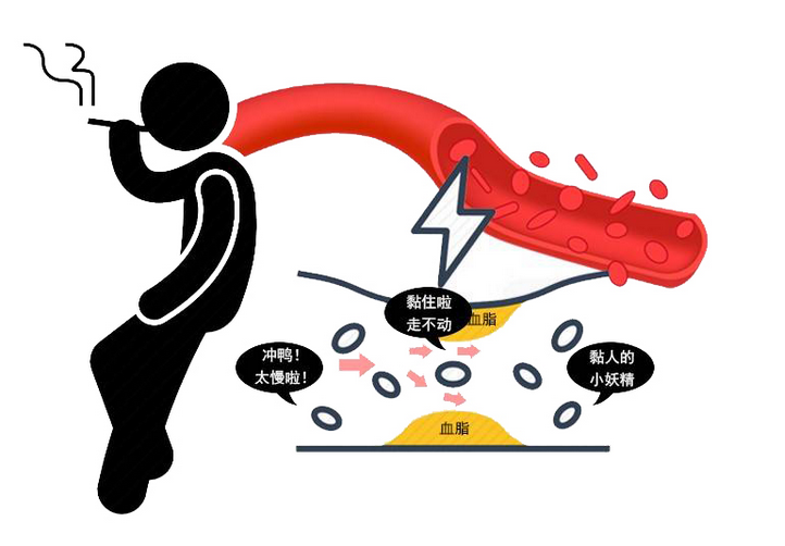 股骨头坏死|酿成心梗的根源：4种不良生活习惯！早点了解，早点戒掉