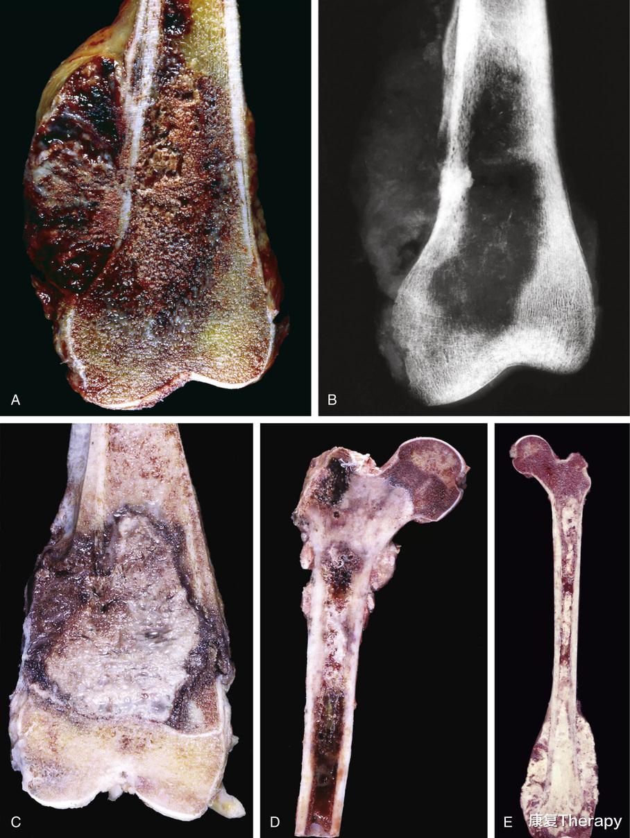 |孩子腿疼，需要重视吗？医生：警惕骨肉瘤，专找孩子下手