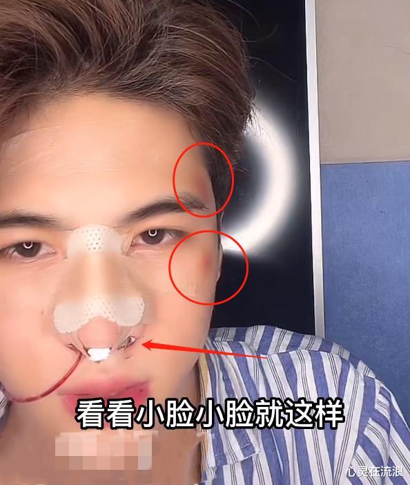 韩安冉|韩安冉00后男友开直播，额头多处淤青，鼻子插管否认挨打