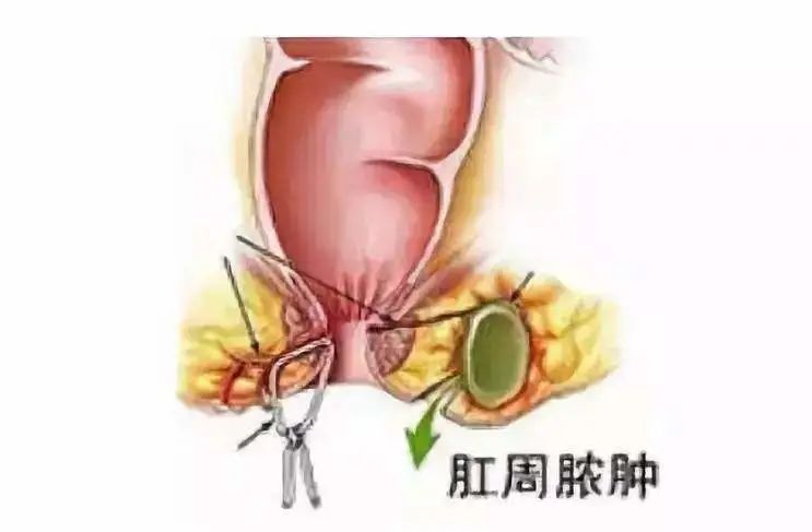 肛周脓肿高位和低位图图片