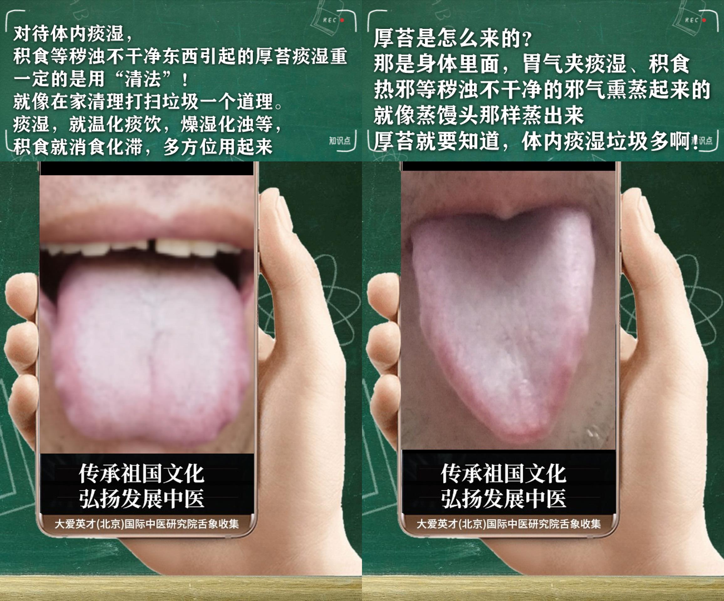 心律失常|反反复复胃胀气,心悸气短,便秘,脾胃不和的舌象案例讲解