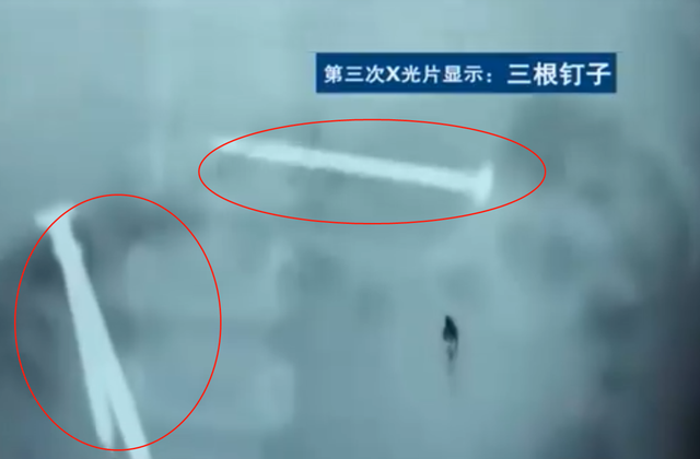 陕西1岁女婴住院期间,体内连续冒出19枚铁钉,医生无奈选择报警!