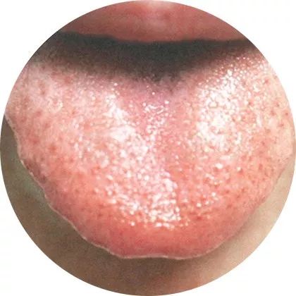 失眠|中医中的舌诊，了解吗