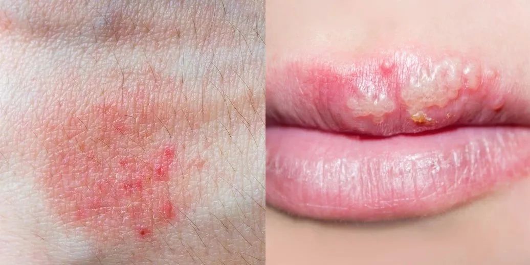 法国 脱皮、爆痘、起红疹，阳过之后皮肤有4大问题，1招教你修护！