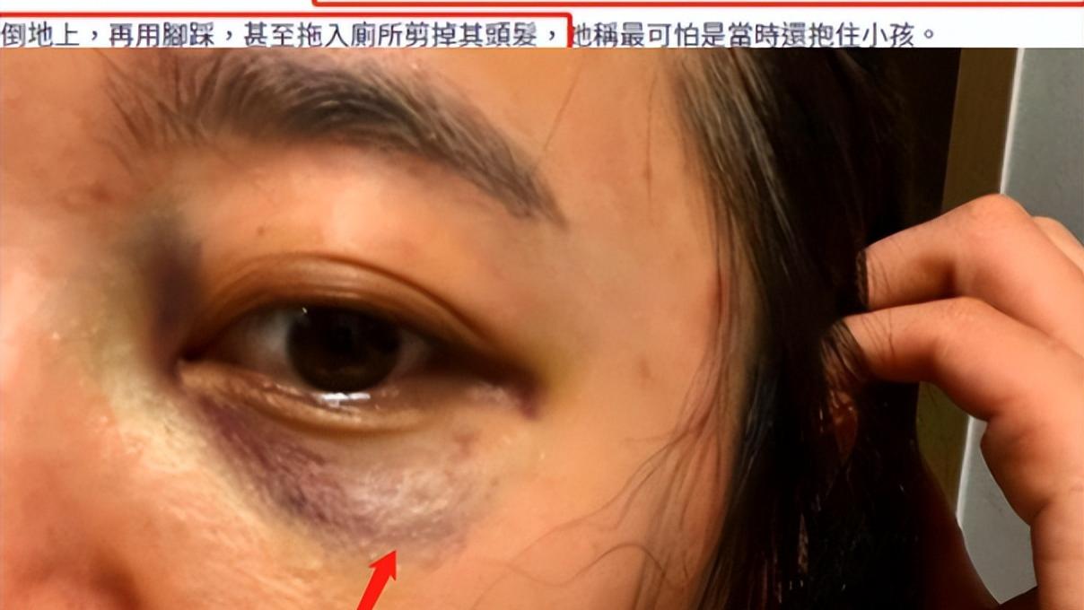 |徐莎朗晒伤控诉家暴遭打脸，多次出轨老公朋友被告，目前已删动态