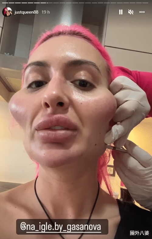 美容|这个动手术打造\世界最高颧骨\的女人，再次向自己的颧骨下手了