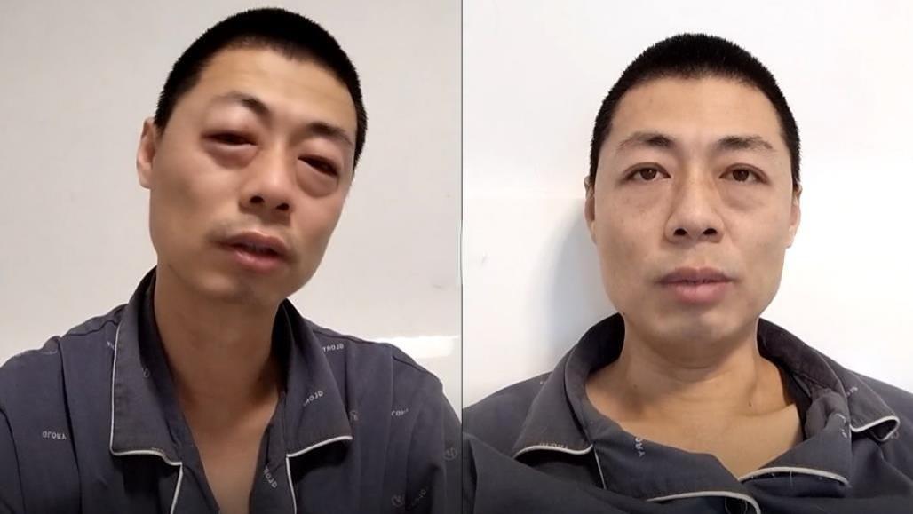 男子自称感染“哭株”流泪眼肿，网友纷纷晒出“睡株”、“炫饭株”、“学习株”
