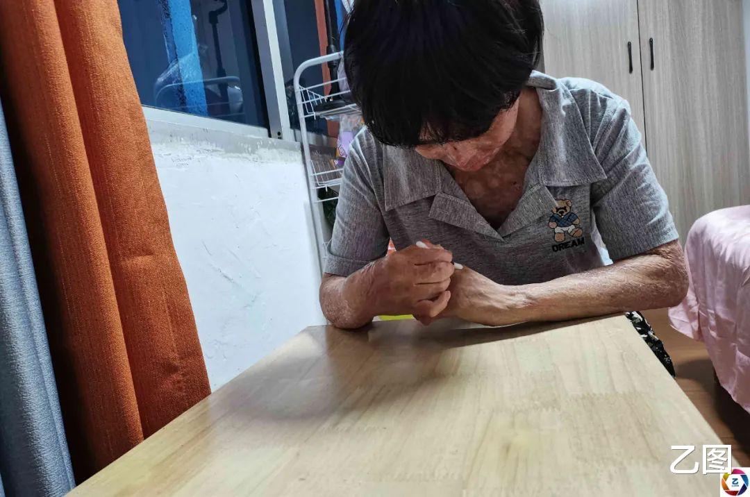 打工妹被女同事泼香蕉水点燃毁容,漂亮的模样如今成痛苦的记忆