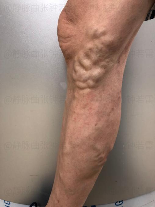 高血脂|中老年静脉曲张的危害有哪些