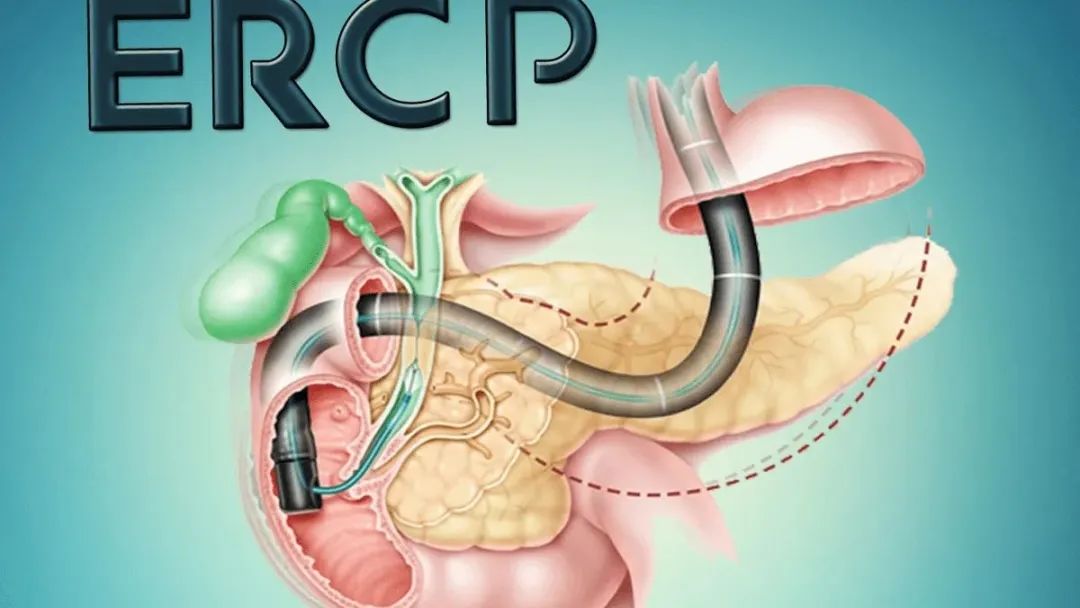 心脏|小结石,大危害|一文读懂胆总管结石的“来龙去脉”
