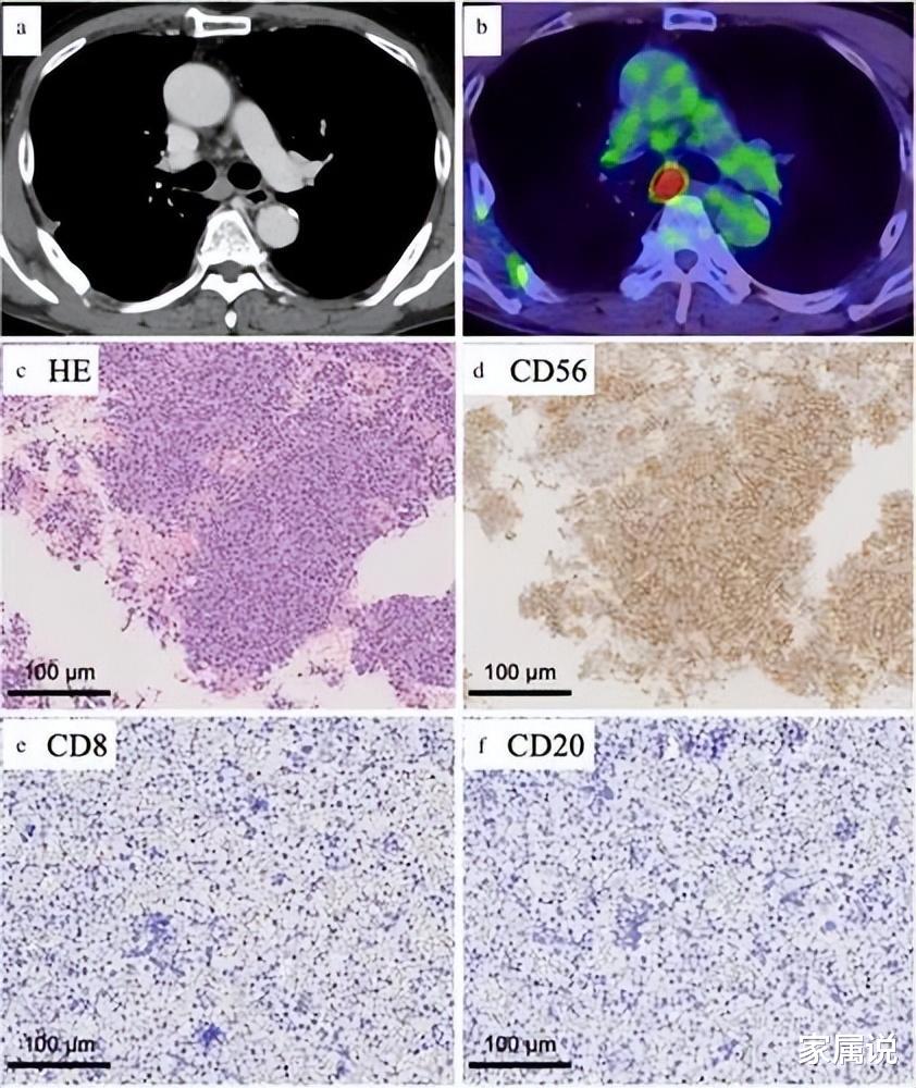 免疫治疗|案例:68岁肺大细胞神经内分泌癌患者接受免疫治疗后4年未复发