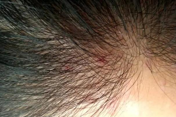 芡实|头皮总是长“疙瘩”和“脓包”,是咋回事?或是这3方面的原因