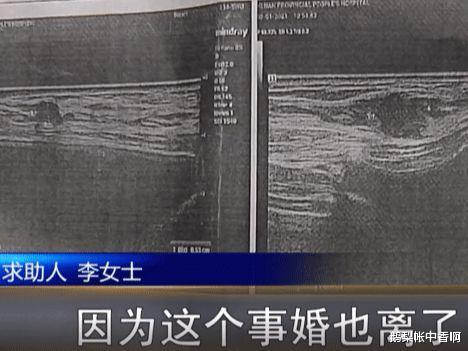 女子隆胸后怒告医院:我才20岁,和老公同房一点知觉都没有