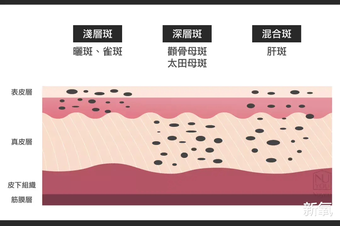 饮食 奶酷少年脸成高奢新宠模特？多亏了她满脸的雀斑…