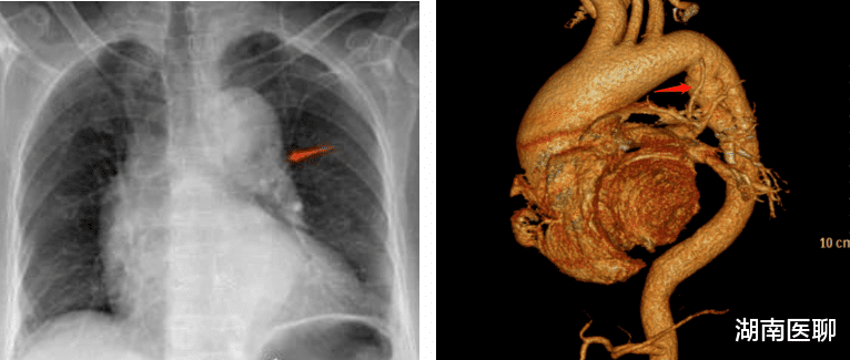 主动脉夹层|一招除“虎患”！石门县人民医院成功救治两例主动脉夹层患者