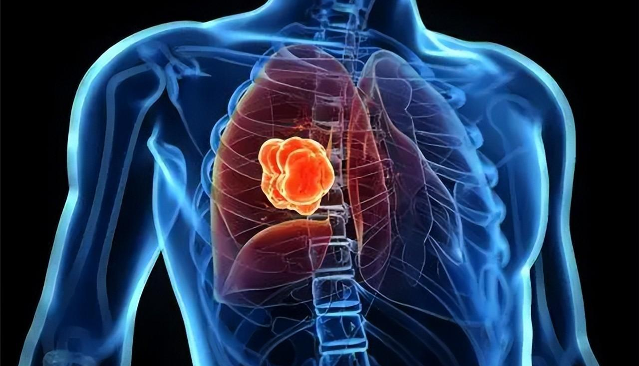 肿瘤|体内有癌，腰部先知？腰痛若有3个特点，警惕癌细胞在“作怪”