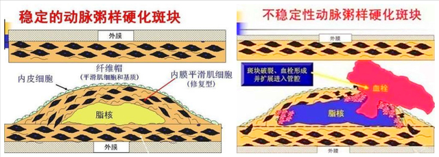 穴位|心梗是什么原因造成的？