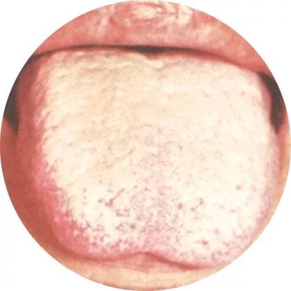 失眠|中医中的舌诊，了解吗