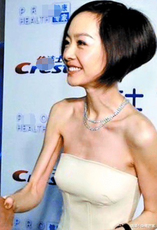 连衣裙 “内卷”下7位暴瘦的女明星,有的瘦到54斤,有的体力不支坐轮椅