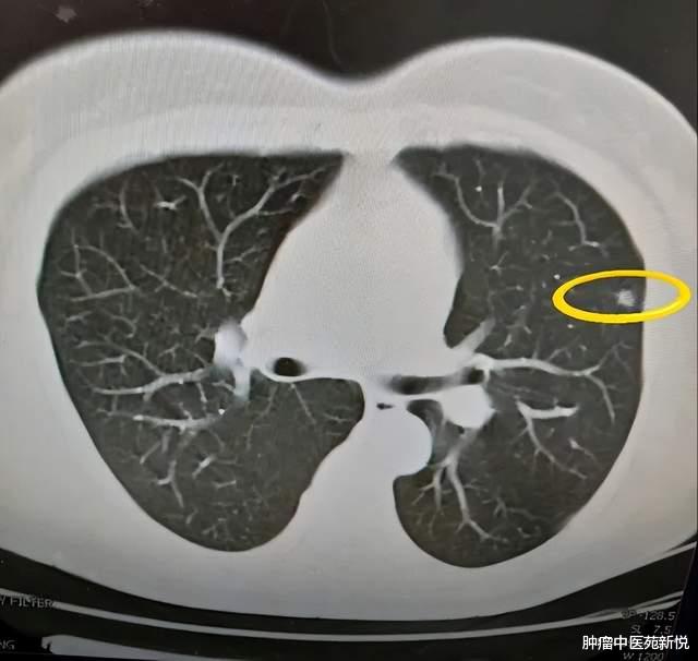 胆固醇|肺结节不能喝冰咖啡？医生忠告：想要肺部健壮，3种食物尽量少碰