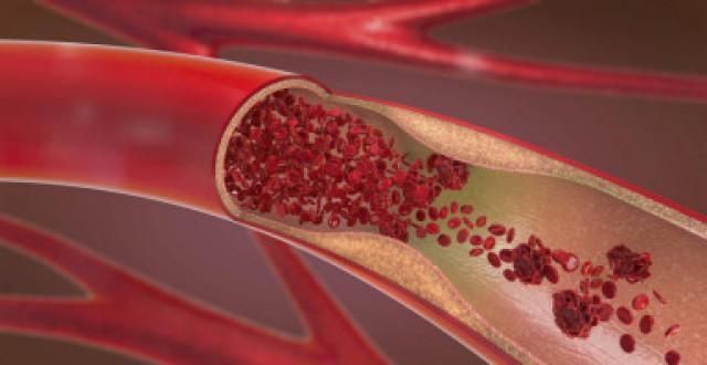 新型冠状肺炎|脑梗患者越来越多，少4物，做3事，防范脑梗，血管也感激你