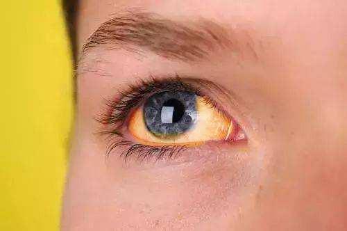 肝脏|肝脏病变时,身体可能“2处变黄,2处长痣”,占一个,最好检查下