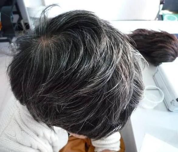 脾胃|白发长在哪,病就从哪出?长在前额、两鬓、后脑勺,分别代表什么