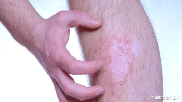 小米粥|【警示】青少年为何易患白癜风?这些不良习惯要丢掉!