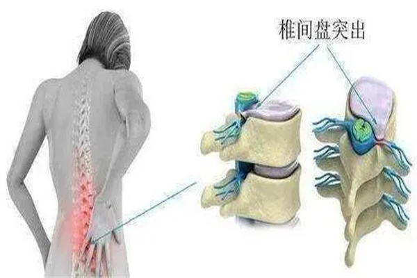 失眠|关于腰椎间盘突出症,你都了解哪些知识?