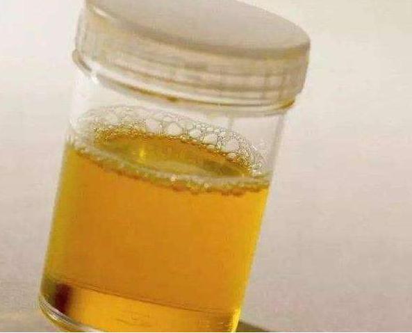 尿毒症|尿毒症是怎么患上的？医生提醒：生活中，建议远离3个坏习惯