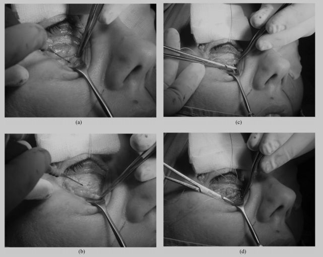 熊师:印第安纹的解剖学特点与治疗进展丨专业视点