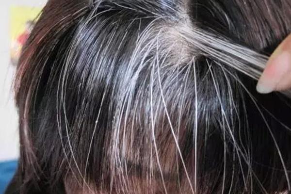 白发|刚进入中年,为何就有人满头白发?多吃2种食物,帮助改善白发