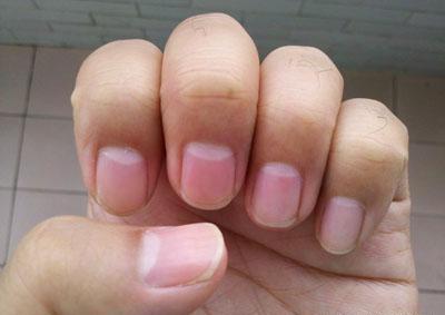 内科|手指甲的“月牙”多了好？还是少了好？内科专家一次性给你说清楚